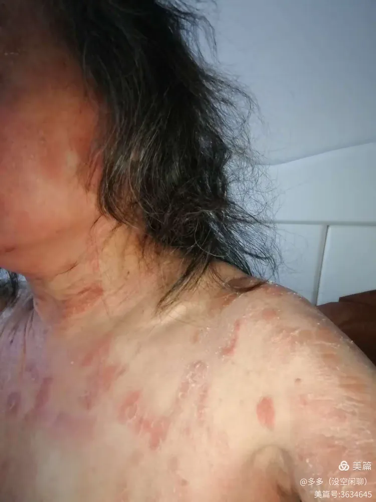 草根医师为我治皮肤病